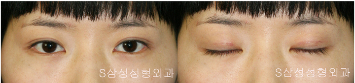 대구쌍수, 자연스러운 쌍꺼풀